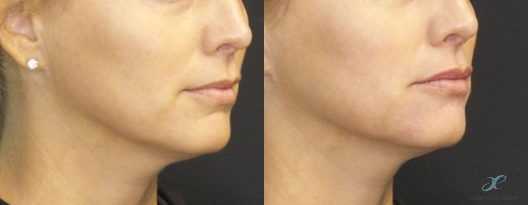 Fillers - Case 10101