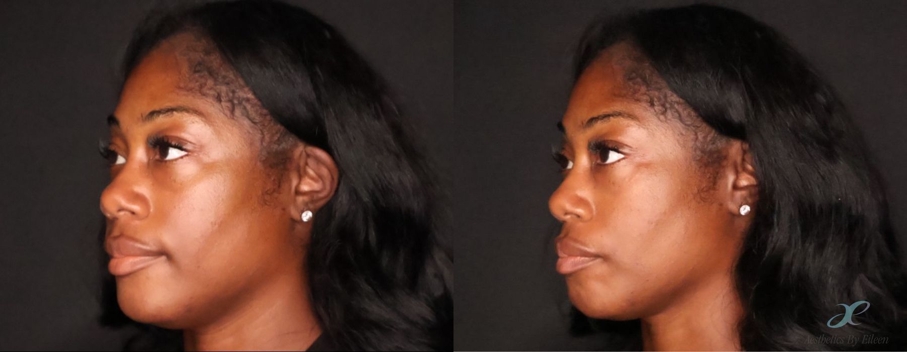 Before and after procedure result