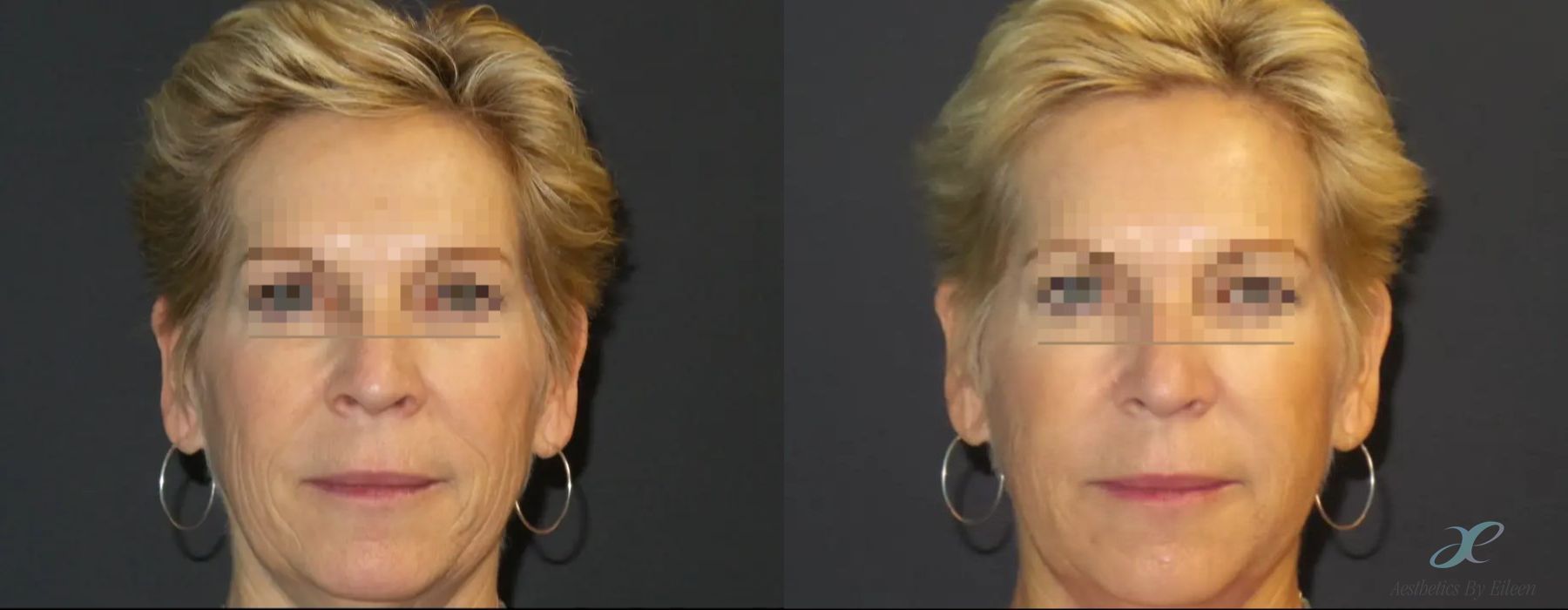 Fillers - Case 10094