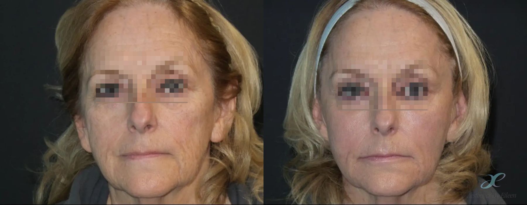 Fillers - Case 10097