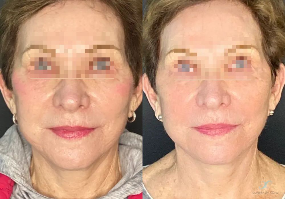 Before and after procedure result