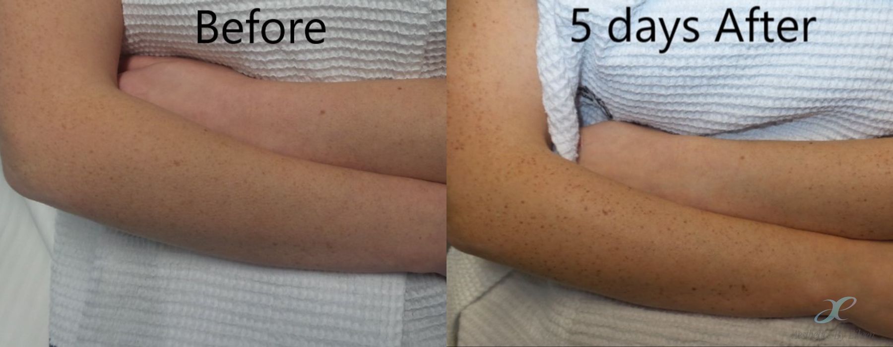 Before and after procedure result