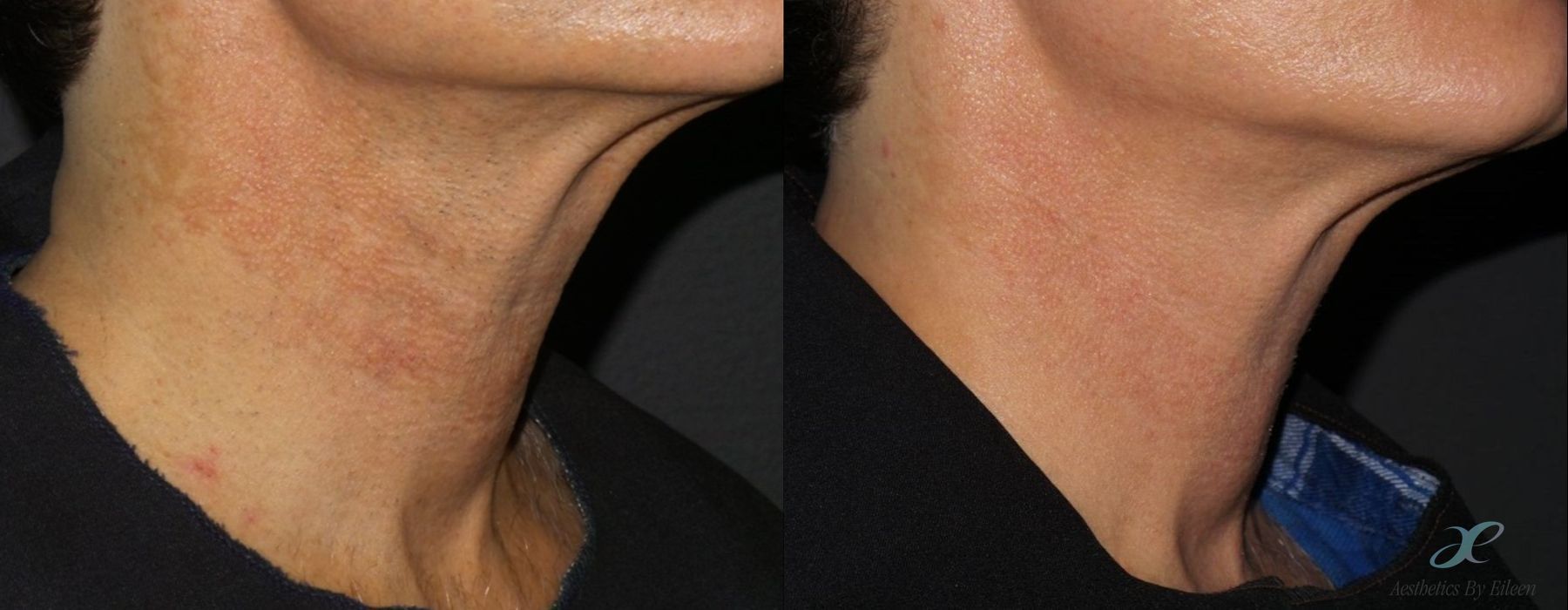 Before and after procedure result