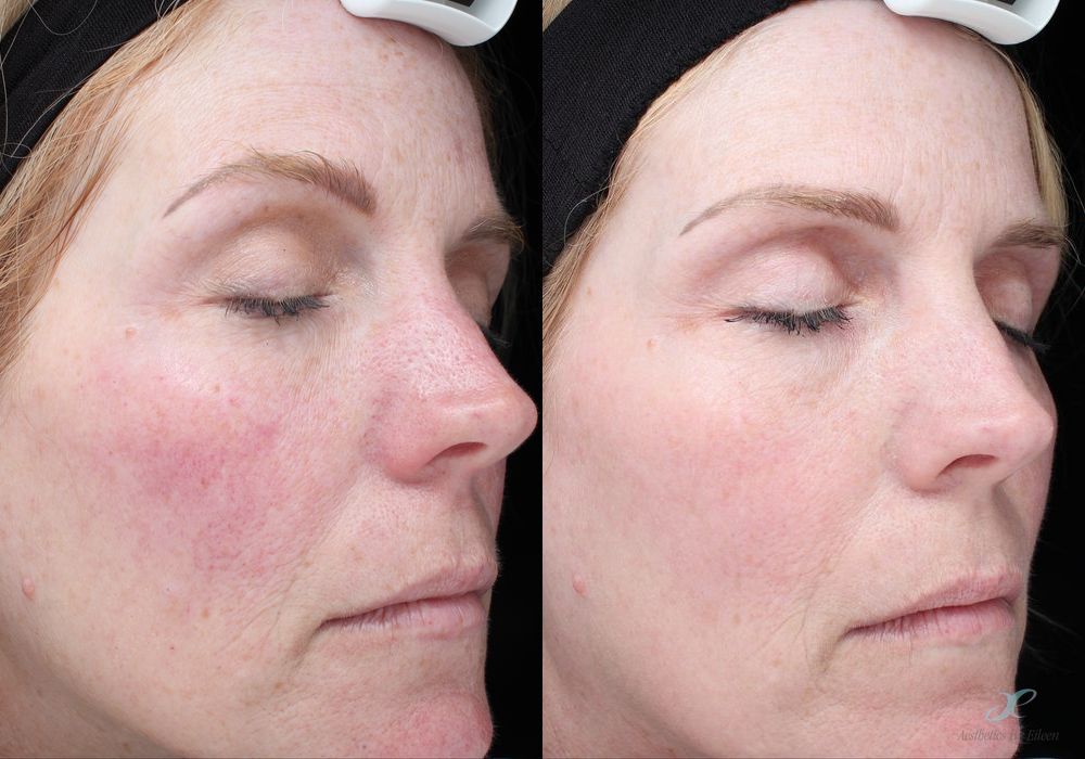 Non-surgical Facial Rejuvenation - Case 10111