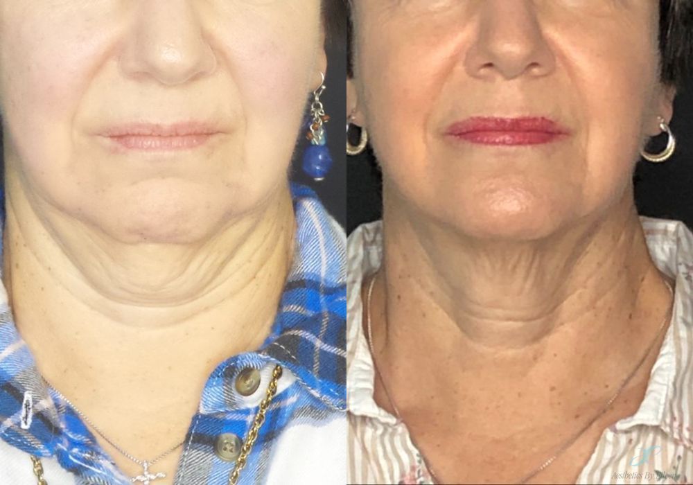 Laser Skin Resurfacing - Case 10127