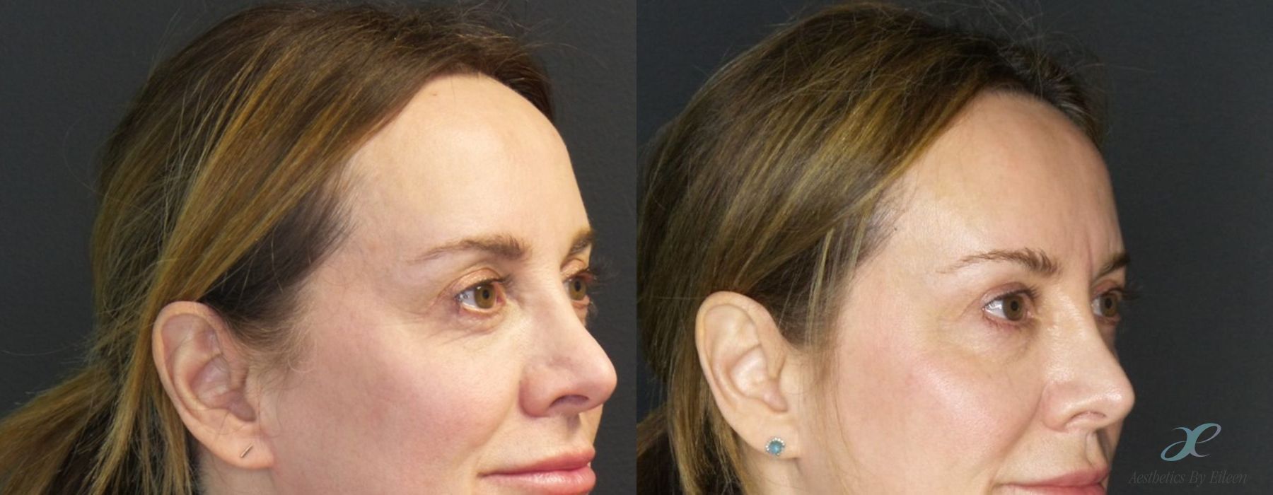 Laser Skin Resurfacing - Case 10122