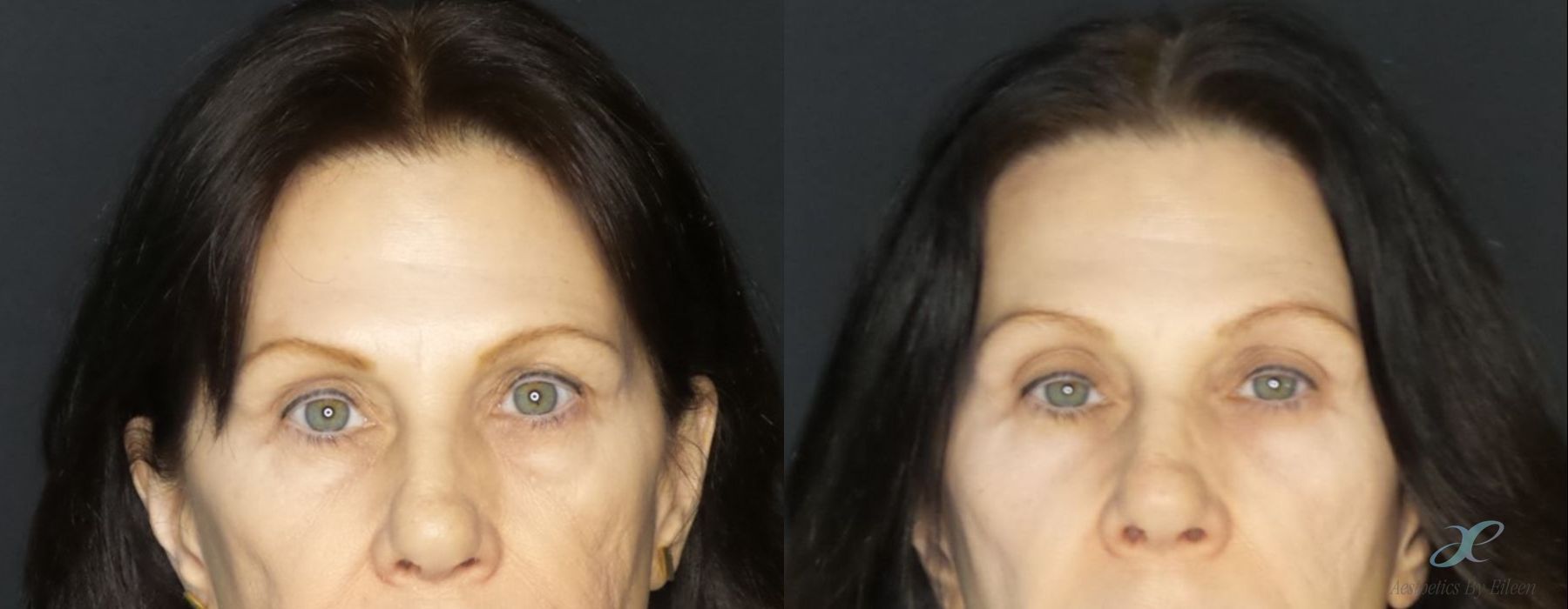 Laser Skin Resurfacing - Case 10128