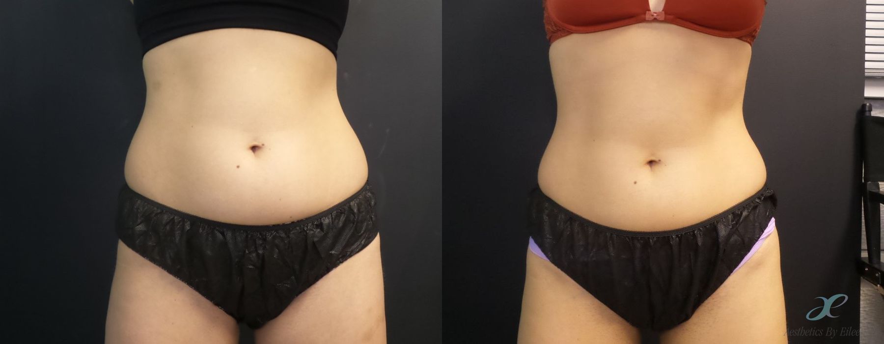 Non-surgical Body Sculpting - Case 10060