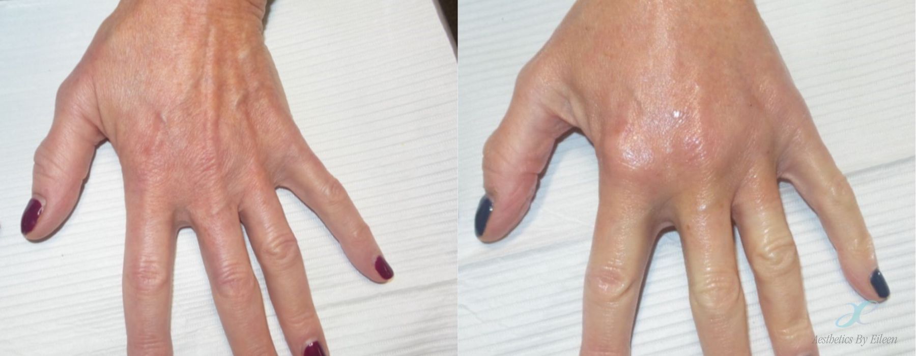 Non-surgical Body Sculpting - Case 10062