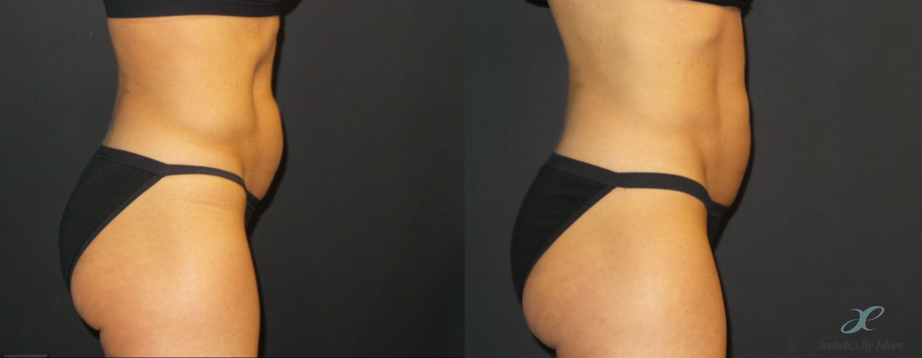 Non-surgical Body Sculpting - Case 10055