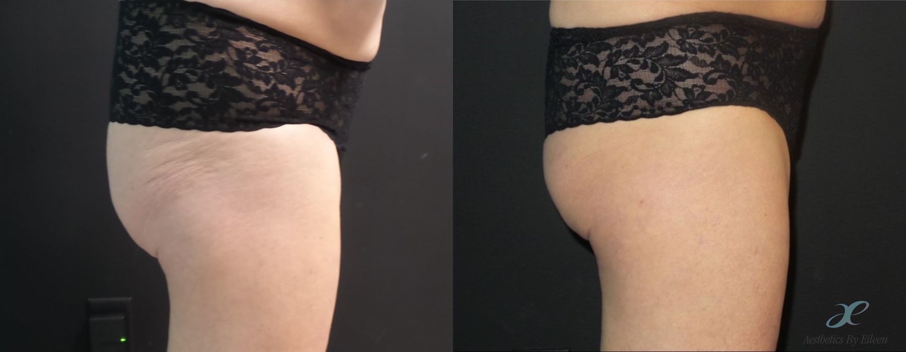 Before and after procedure result