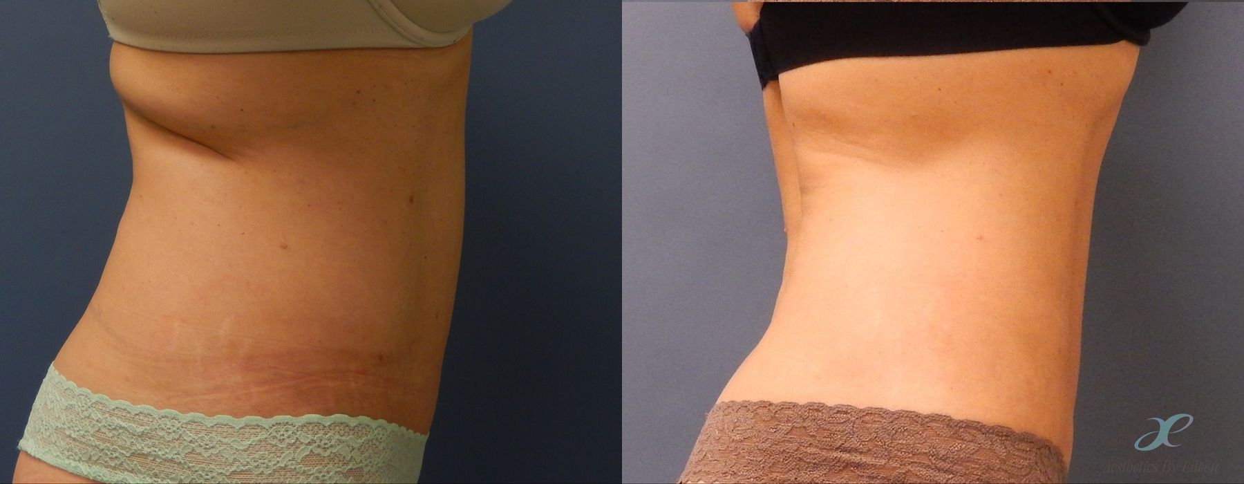 Before and after procedure result