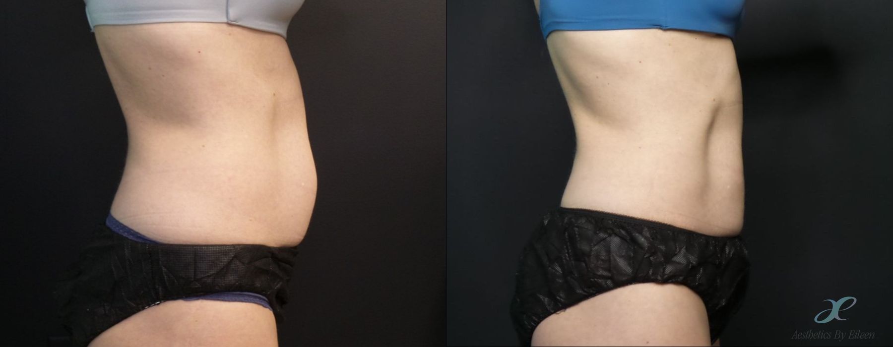 Before and after procedure result