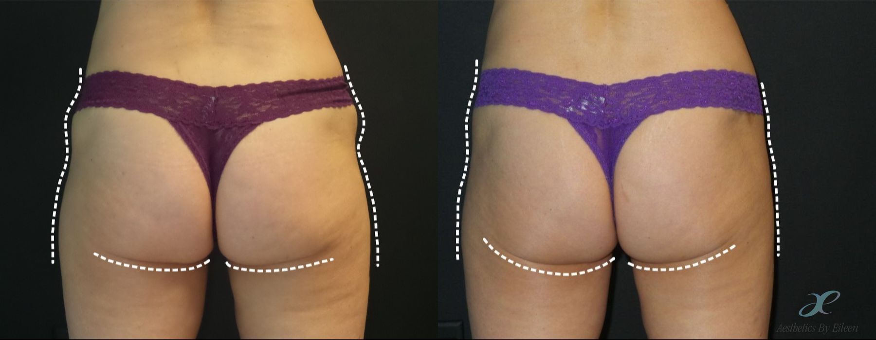 Before and after procedure result