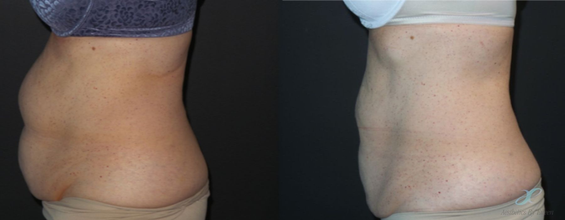 Before and after procedure result