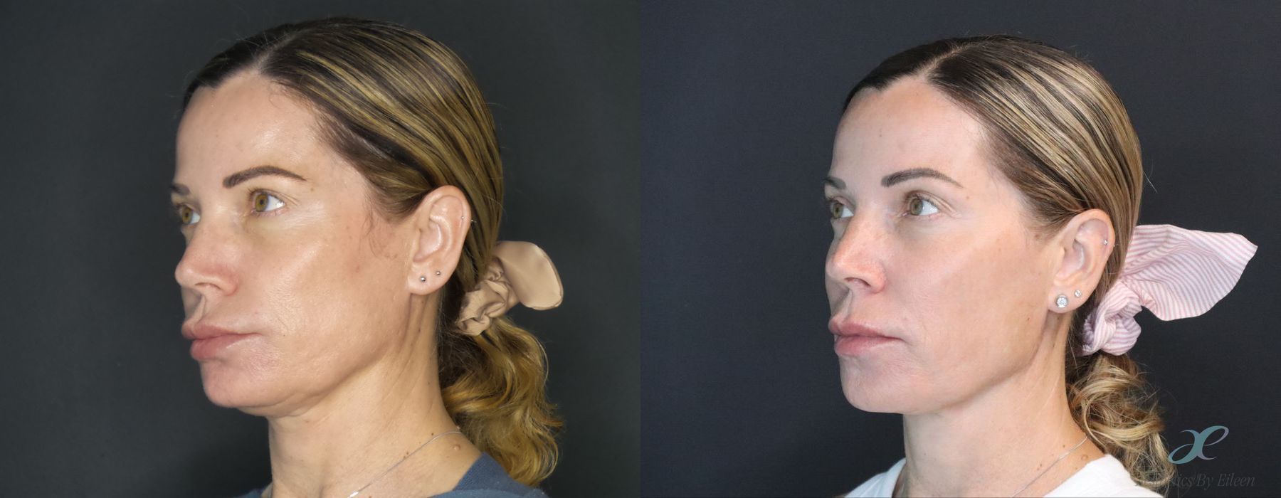 Before and after procedure result