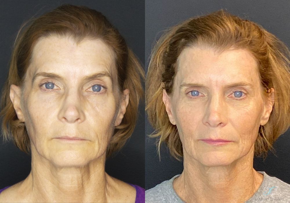 Before and after procedure result