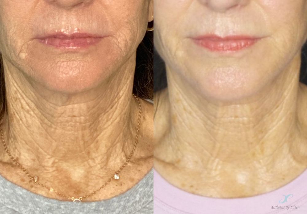 Before and after procedure result