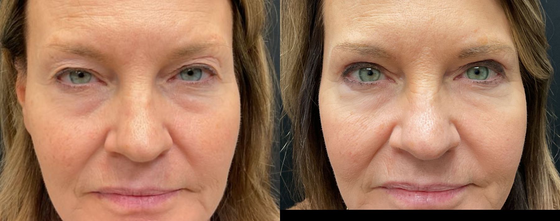 Upper Eyelid Blepharoplasty Results | Before and After