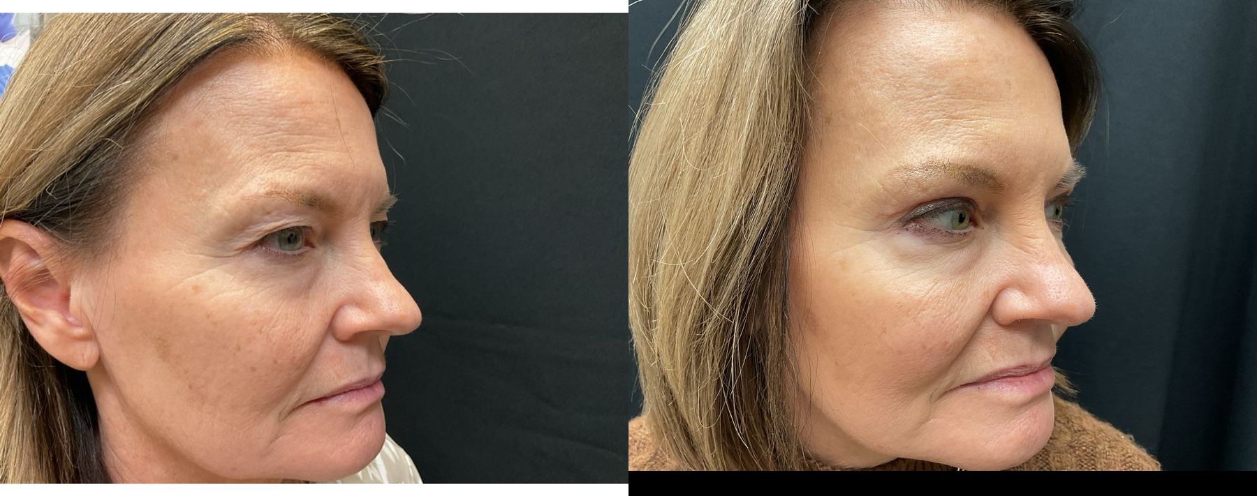 Upper Eyelid Blepharoplasty Results | Before and After - Angle 2