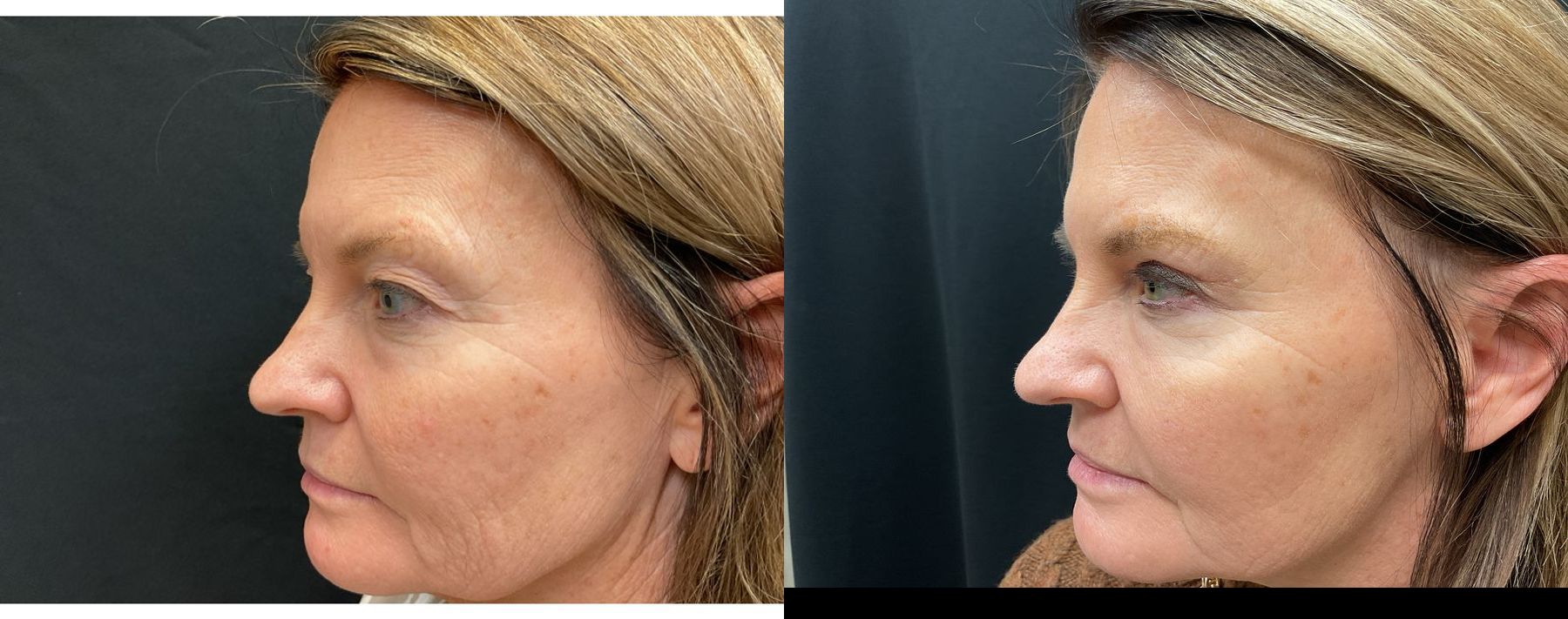 Upper Eyelid Blepharoplasty Results | Before and After - Angle 3