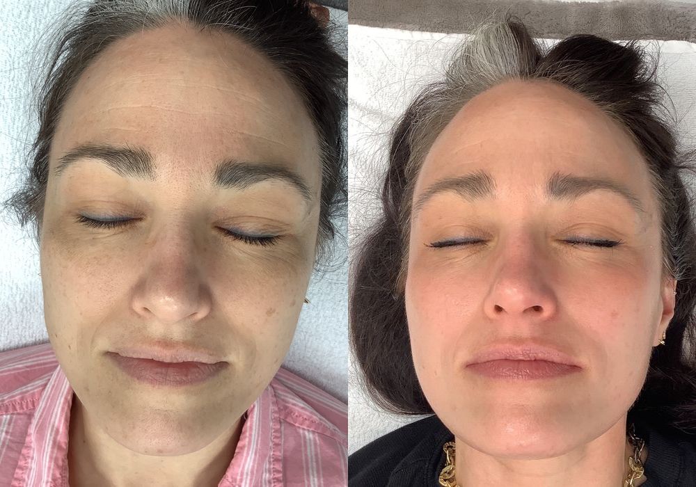 Chemical Peels - Case 5310