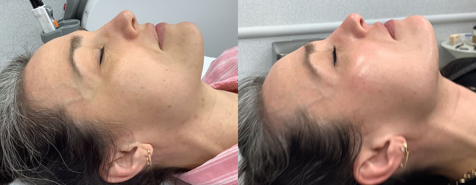 Chemical Peels - Thumbnail 2