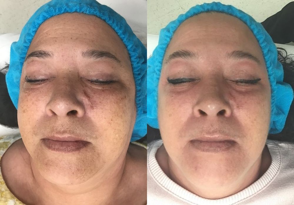 Chemical Peels - Thumbnail 3