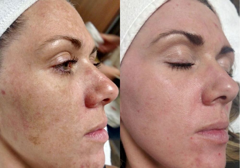 Chemical Peels - Case 5313