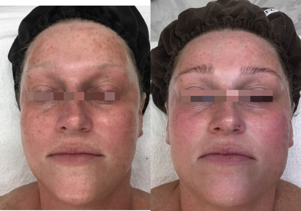 Chemical Peels - Case 5302