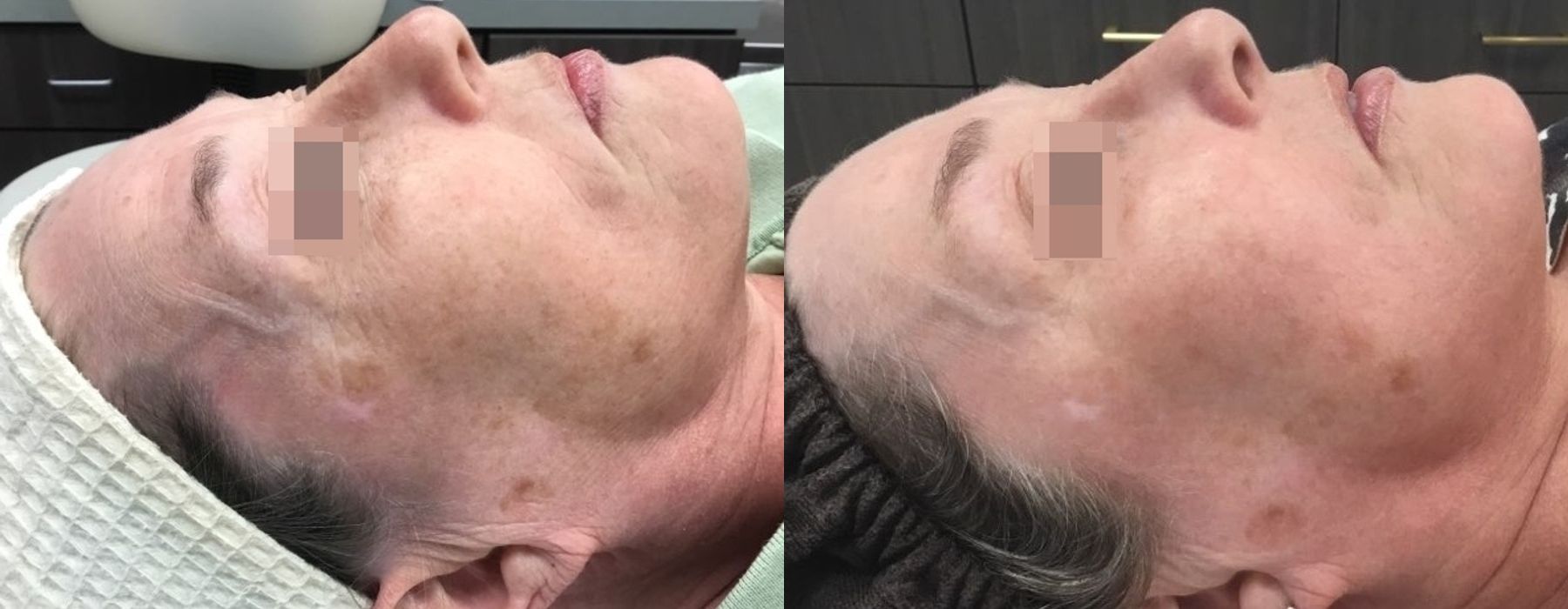 Chemical Peels - Thumbnail 3