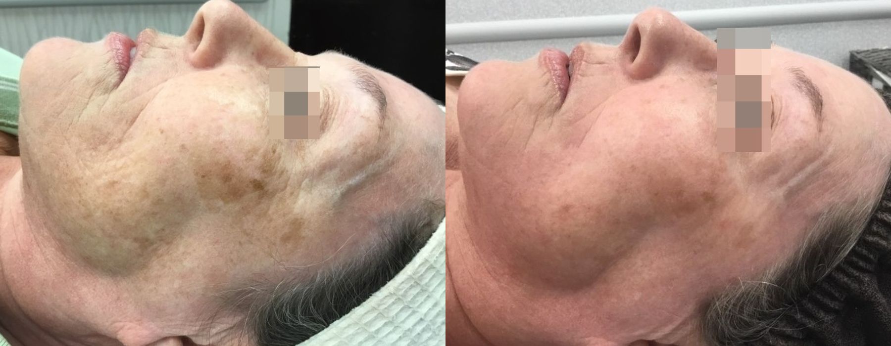 Chemical Peels - Thumbnail 2