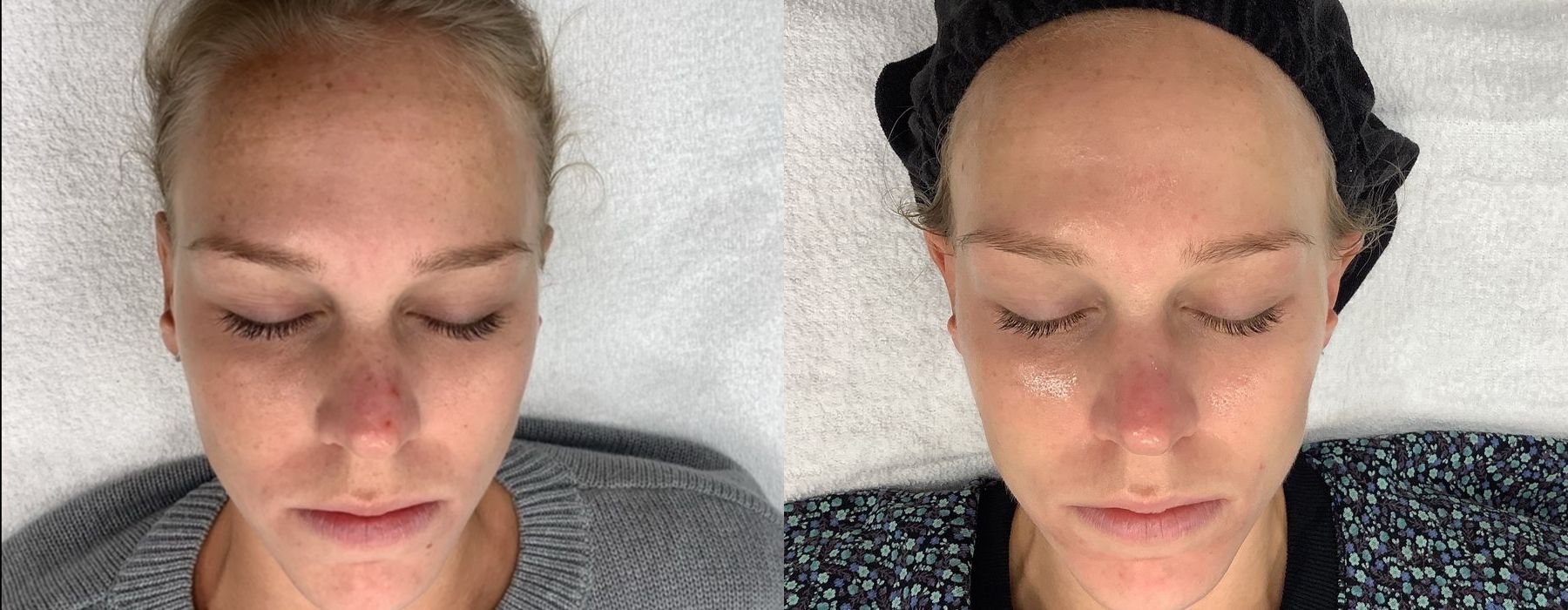 Chemical Peels - Case 5306