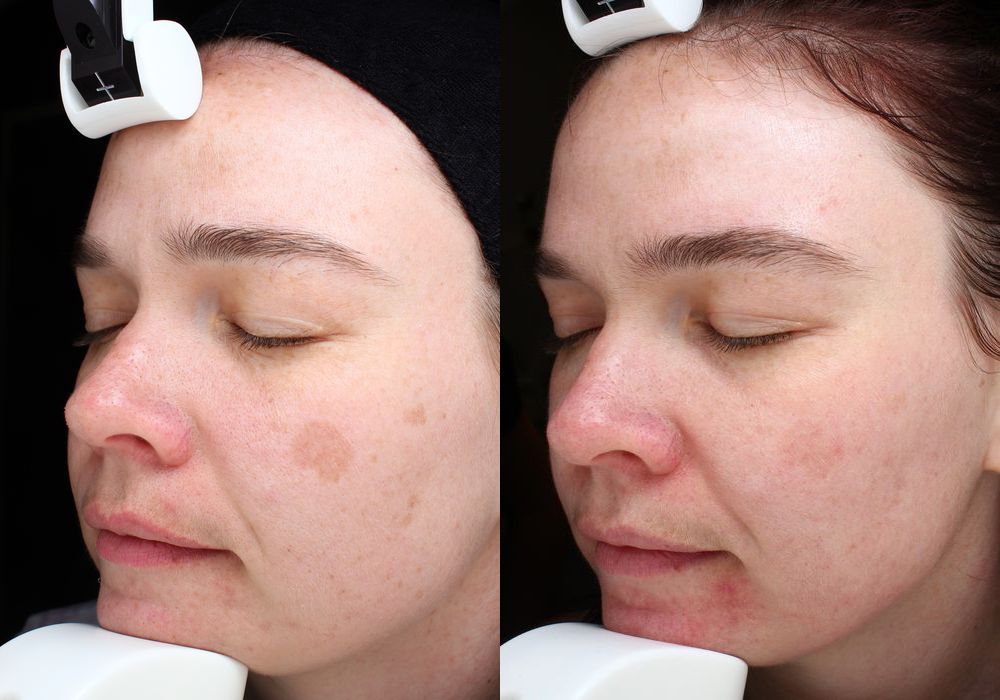 Chemical Peels - Case 5311