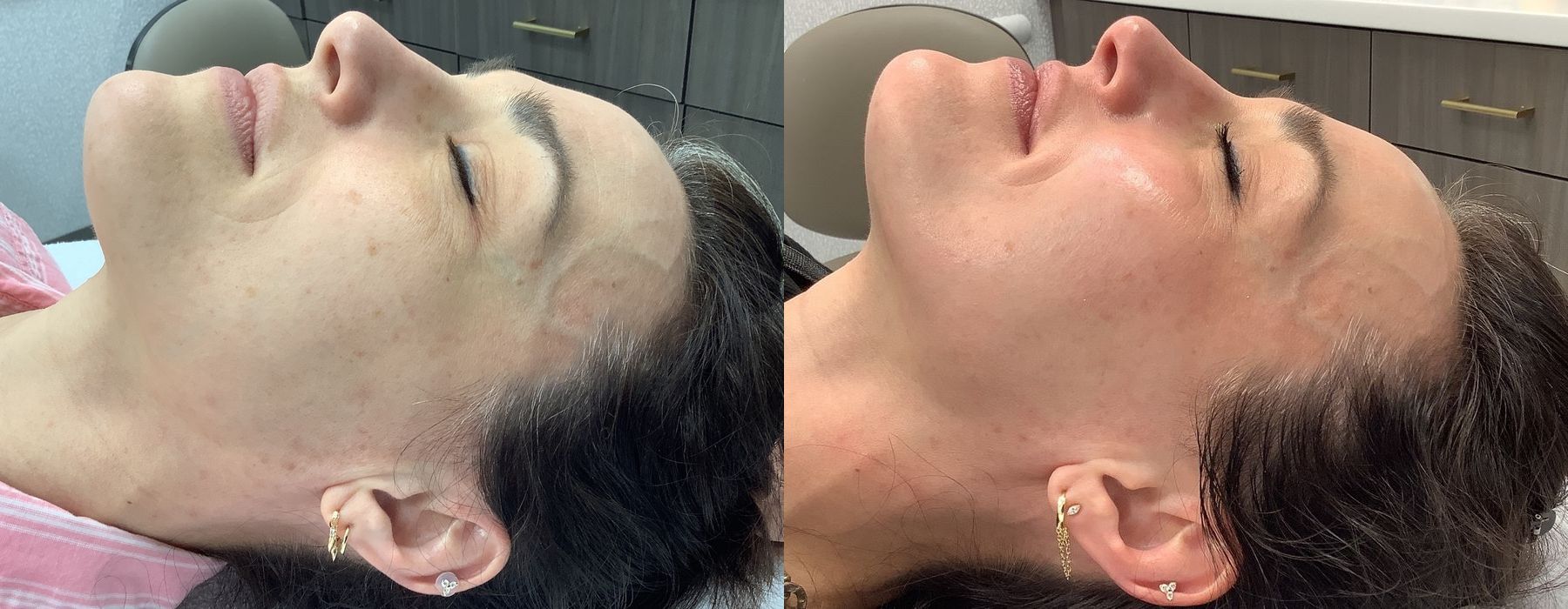 Chemical Peels - Thumbnail 3