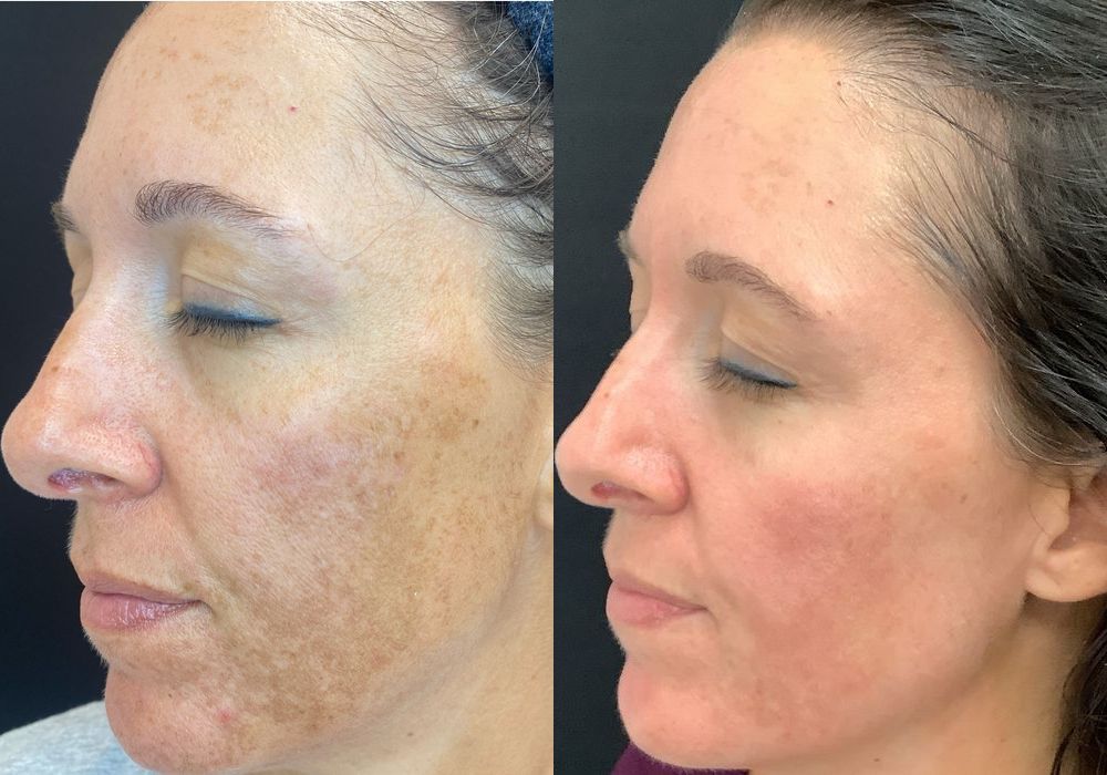 Chemical Peels - Thumbnail 3