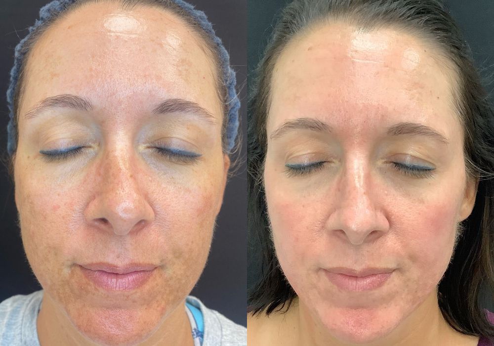 Chemical Peels - Case 5309