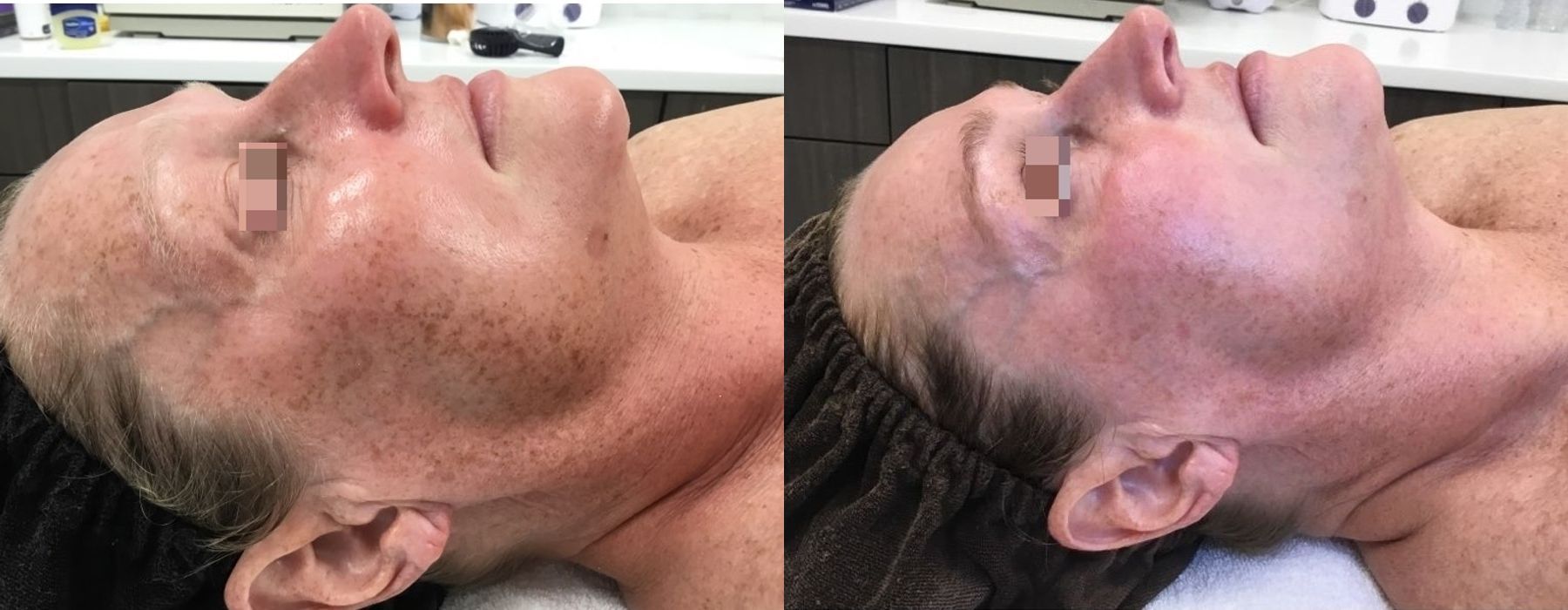 Chemical Peels - Thumbnail 2