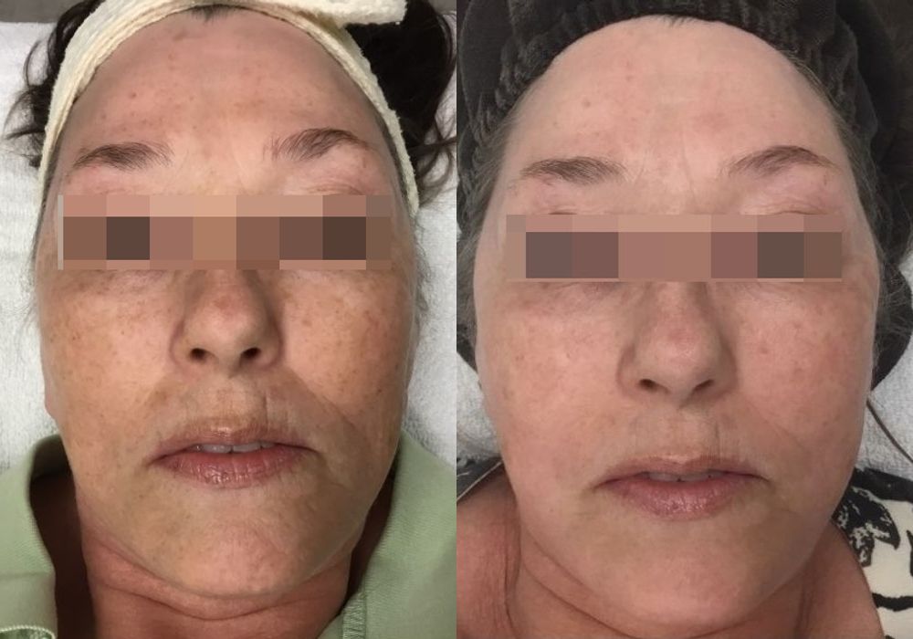Chemical Peels - Case 5304
