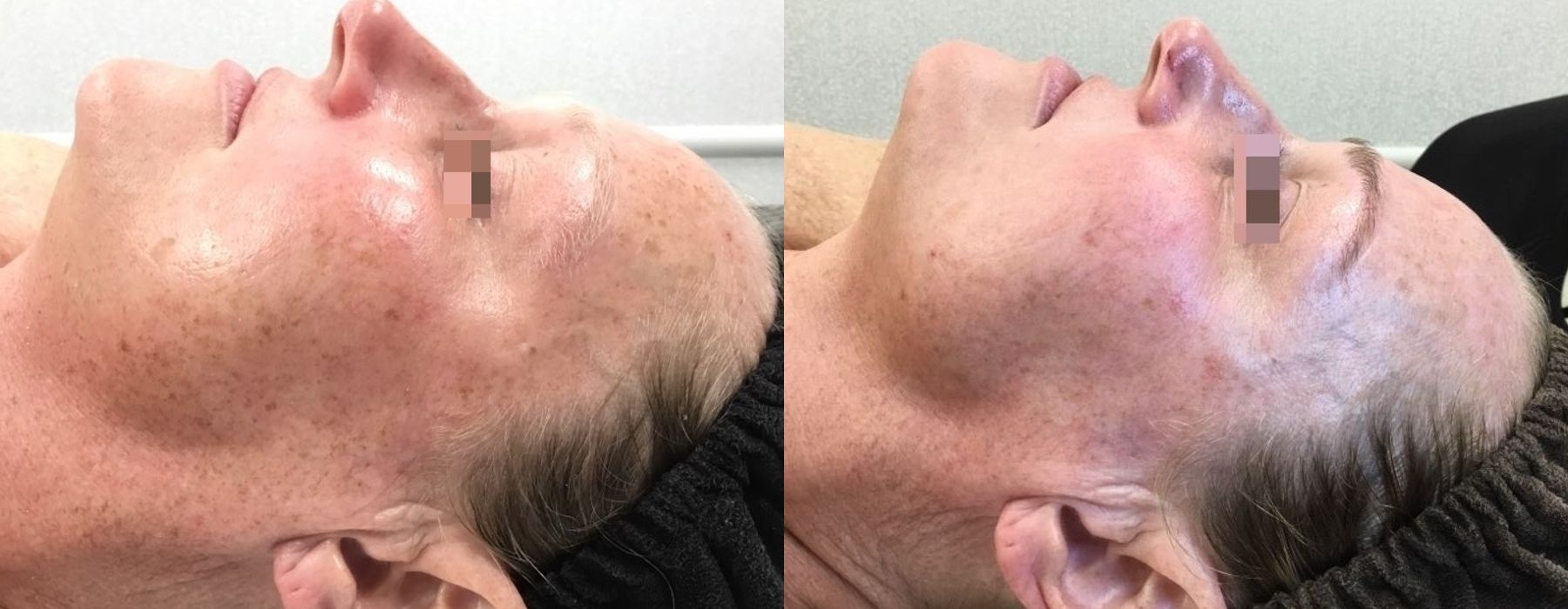 Chemical Peels - Thumbnail 3