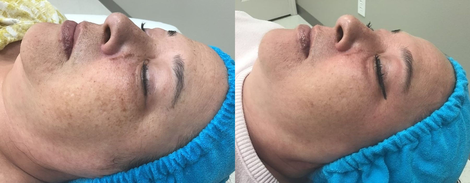 Chemical Peels - Thumbnail 2