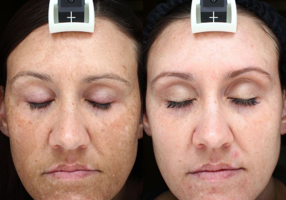 Chemical Peels - Case 5303