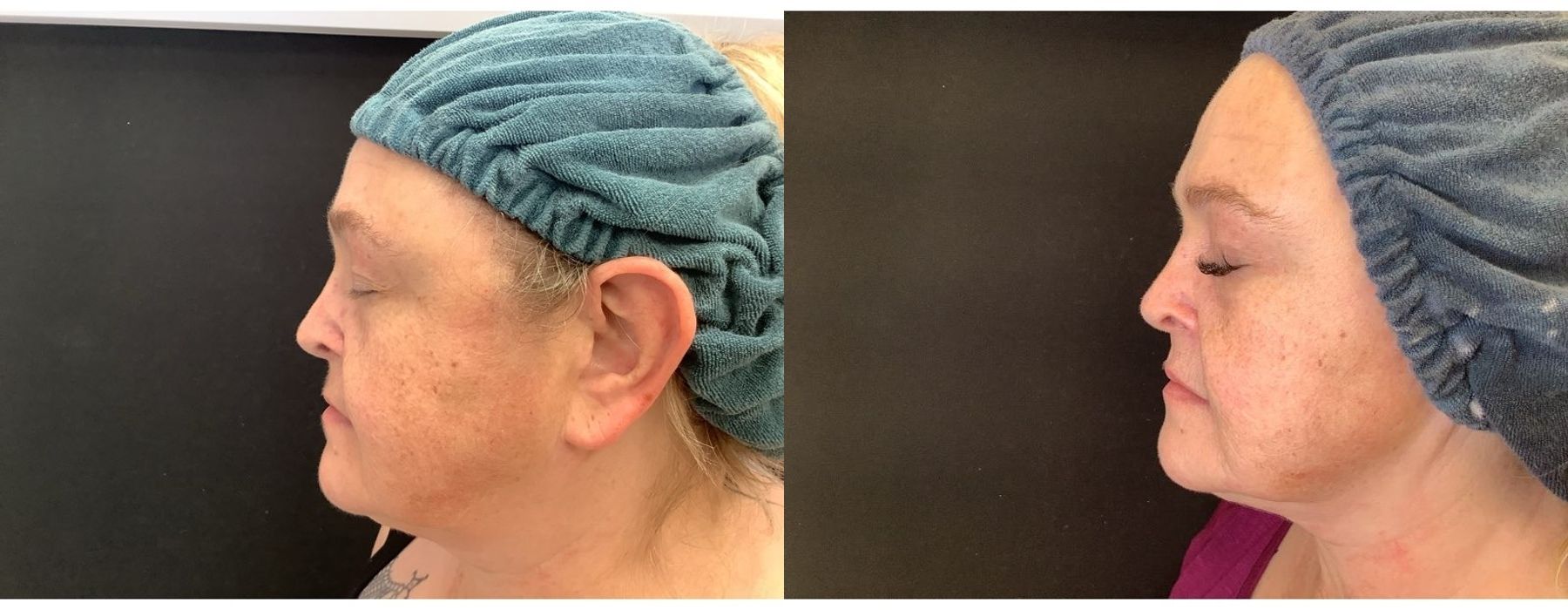 Chemical Peels - Thumbnail 2