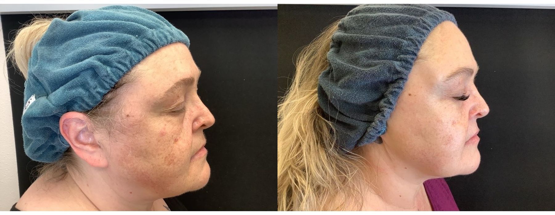 Chemical Peels - Thumbnail 3