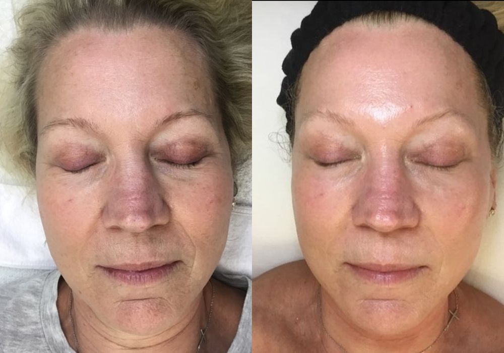 Before and after procedure result