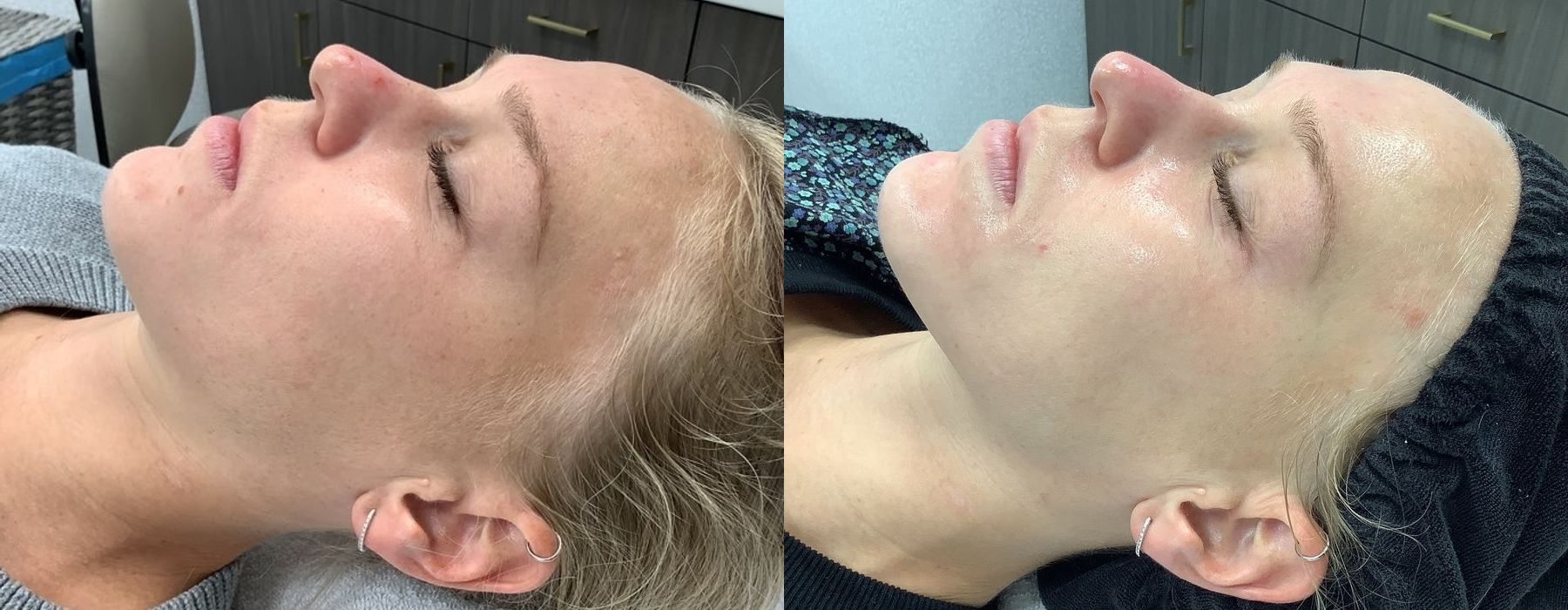 Chemical Peels - Thumbnail 3