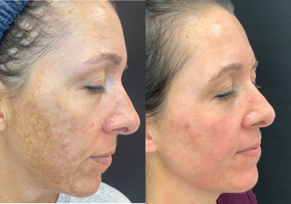 Chemical Peels - Thumbnail 2