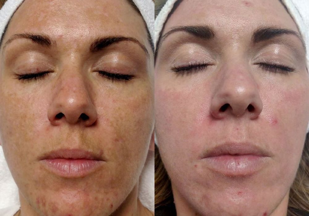 Chemical Peels - Thumbnail 2