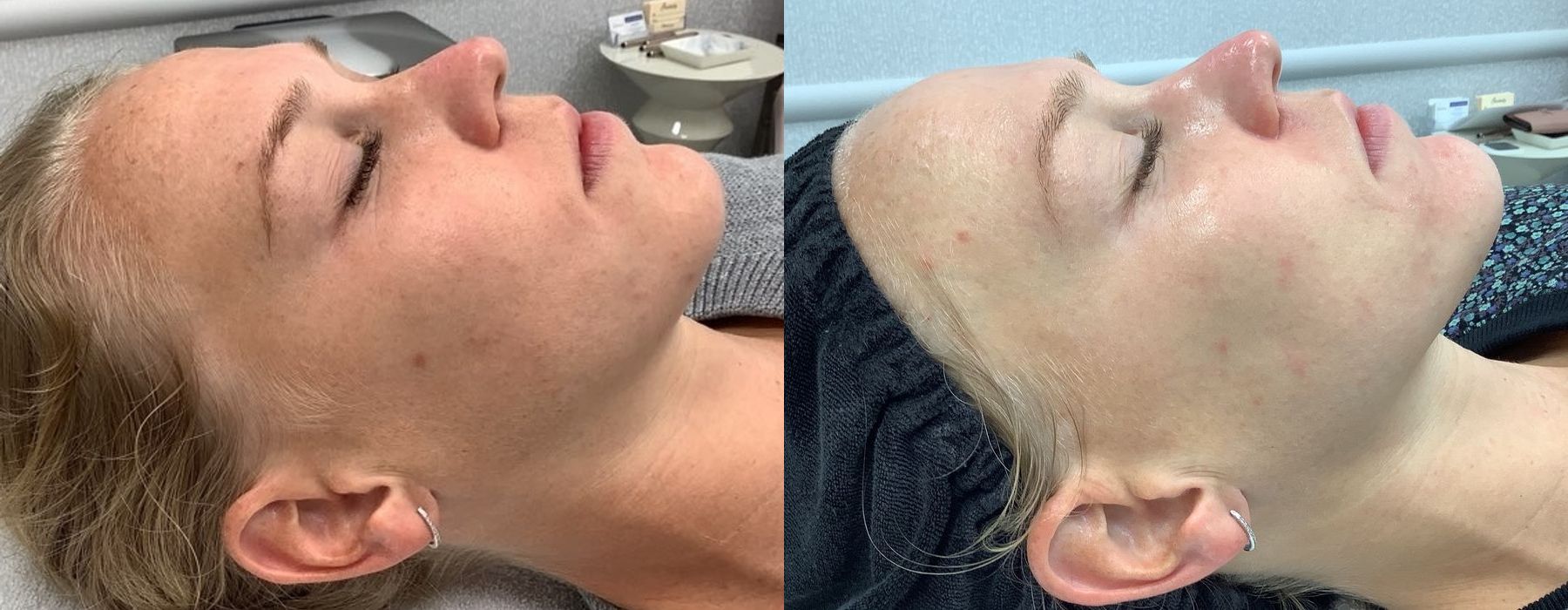 Chemical Peels - Thumbnail 2