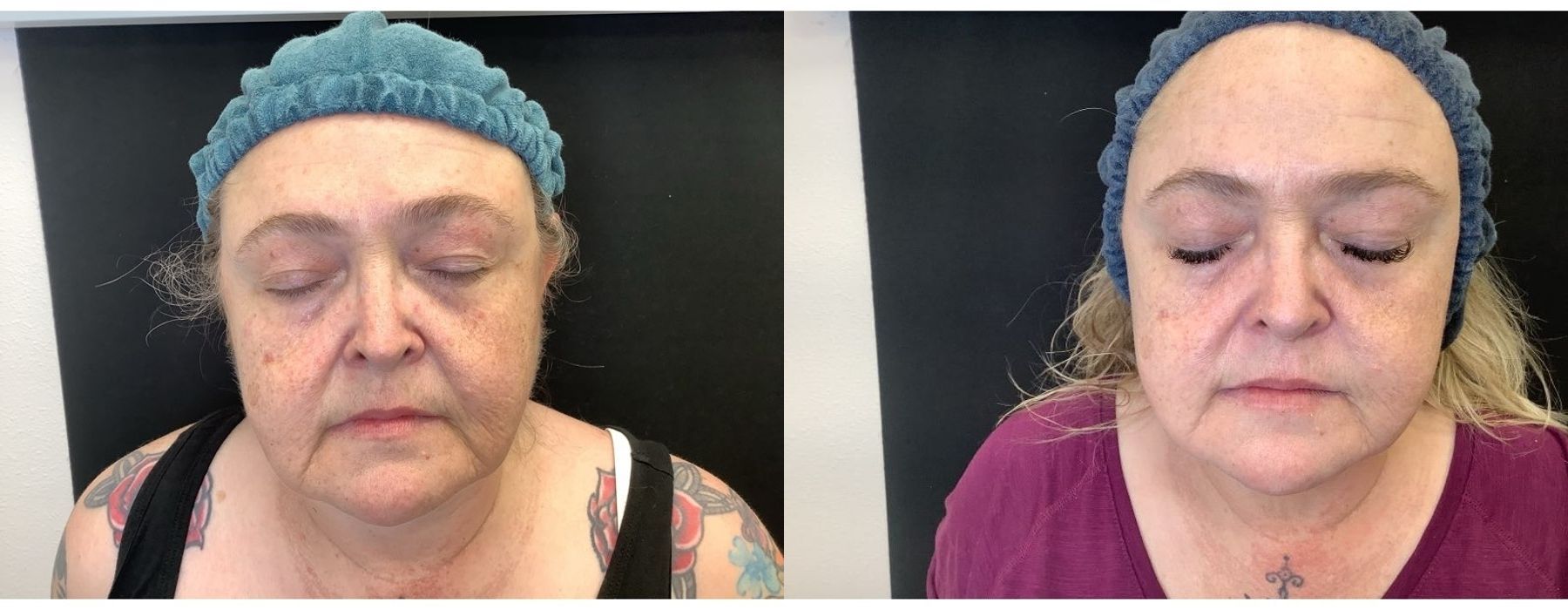 Chemical Peels - Case 5314